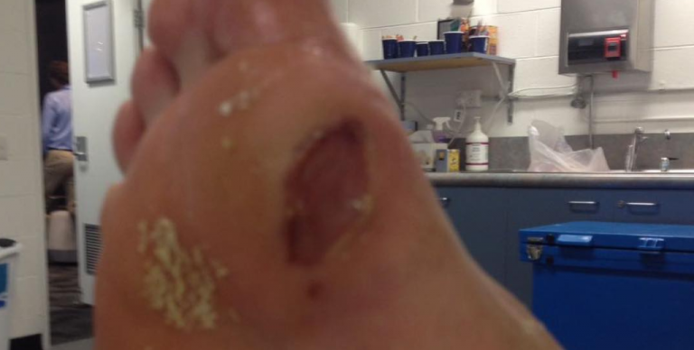 [FOTOS] Chung mostra como ficaram os seus pés: «Por favor entendam-me»